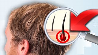 What Actually Causes Hair Loss [upl. by Rosamond125]