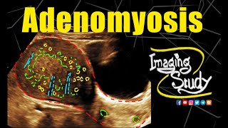 Adenomyosis  Uterus  Ultrasound  Case 330 [upl. by Jeffry878]