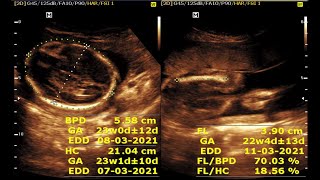 Ultrasound cases 140 of 2000  Video showing About 23 wks 1 days of single viable pregnancy [upl. by Frendel]