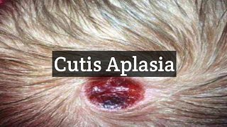 Cutis Aplasia  A skin Condition With Missing Skin Areas [upl. by Yetac]