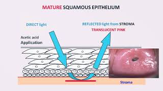 Colposcopy – Technique and Interpretation by Dr Usha Saraiya [upl. by Ardnait]