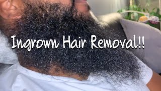 The Most Satisfying Ingrown Hair Removal From Beard [upl. by Retsek]