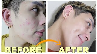 WORST ACNE BREAKOUT PAANO ANG GINAWA KONG TREATMENT SIR LAWRENCE [upl. by Paviour]