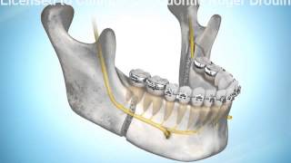 Avancement de la mandibule par chirurgie [upl. by Attenat]