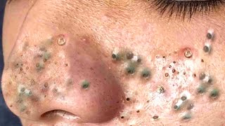 Big Cystic Acne Blackheads Extraction Blackheads amp Milia Whiteheads Removal Pimple Popping  9014 [upl. by Trebla478]