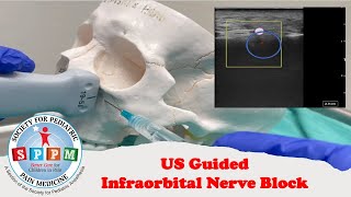 Infraorbital Nerve Block Ultrasound Guided [upl. by Nwahsirhc333]