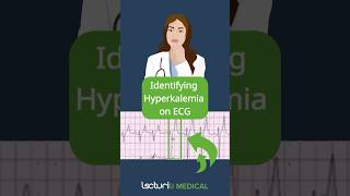 Key ECG Clues for Hyperkalemia 📊 [upl. by Sirrep257]