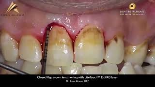 Closed flap crown lengthening with LiteTouch™ ErYAG laser [upl. by Lednik]