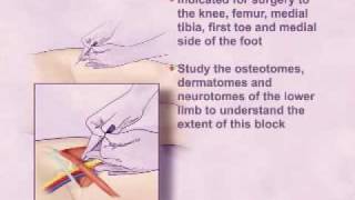 Single Injection Femoral Nerve Block [upl. by Eemla]