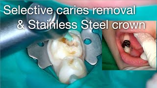 Selective caries removal amp stainless steel crown [upl. by Nallaf]