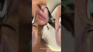 Botox Injection Sites for Crows Feet Bunny Lines amp Droopy Smile  Dr Kami Parsa [upl. by Otiragram]