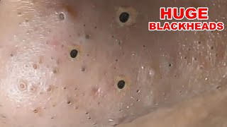 Blackheads Extraction On The Nose part 1 [upl. by Olli]