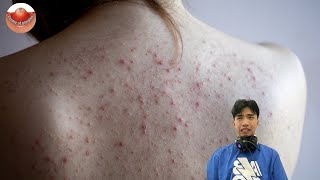 The MOST TERRIFYING Acne Squeezing Videos Youve Ever Seen 3 [upl. by Ekul]