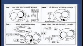 Pre  excitation syndromes  Dr Shashidhar 29092013 18 [upl. by Aneahs]