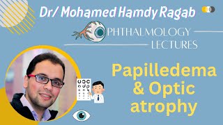 Neuro 3 Papilledema amp Optic atrophy [upl. by Innad]