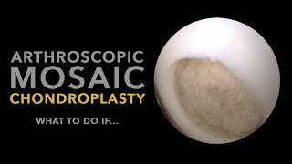 Arthroscopic mosaic chondroplasty [upl. by Brine]