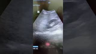 Mild Fatty Liver ultrasound shortvideo short [upl. by Isadore9]