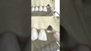 Diş Kemiği Ekleme Kemik Grefti Nasıl Yapılır drlacin periodonta kemikgrefti [upl. by Loss893]