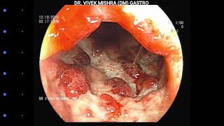 Chronic Ulcerative Colitis  Colonoscopy [upl. by Annwahsal]