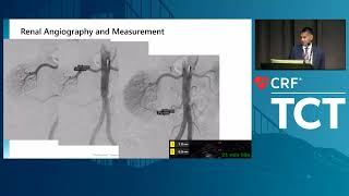 The Next Wave of Hypertension Management  Ultrasound RDN Technology and Clinical Evidence [upl. by Ragde]