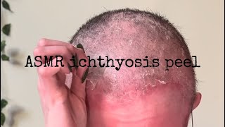 Ichthyosis ASMR peeling [upl. by Tiphane]