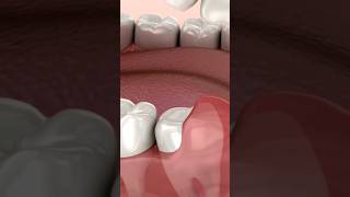 quotPericoronitis amp Wisdom Teeth Pain Causes Explained  DentalHealth365quotshorts viralvideo short [upl. by Askari471]