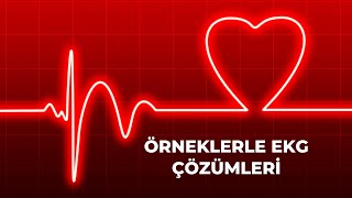 Örneklerle EKG Çözümleri [upl. by Ardra202]