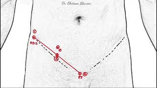 Surface marking of inguinal canal and its clinical correlations [upl. by Ybbor]