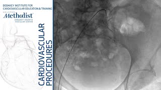 Diagnostic Angiogram Maham Rahimi MD Yusuf Chauhan MD [upl. by Darn]