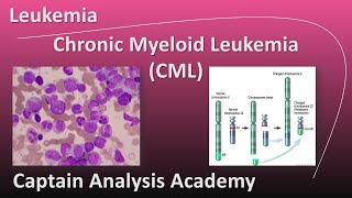 E5 Chronic myeloid leukemia CML Philadelphia chromosome سرطان الدم الميلودى النخاعى المزمن [upl. by Suoivatnom863]