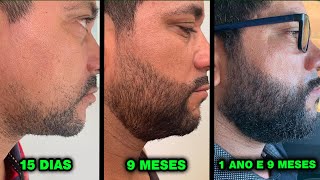 ELE USOU MINOXIDIL aos 38 ANOS evolução minoxidil [upl. by Constant956]