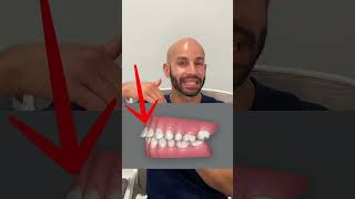 Overbite Correction with Invisalign Our Smile Design Plan [upl. by Amzu812]