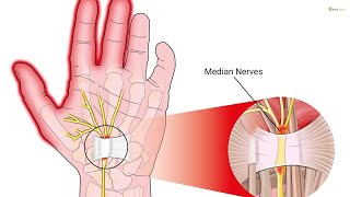 Tunnel carpale sintomi ed esercizi [upl. by Enelyt]
