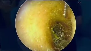 Oddly Satisfying Video Removing Massive Ear Wax Blockages [upl. by Norvol]