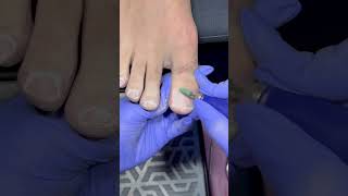 Pedicure transformation nailcare nailtreatment nails pedicure [upl. by Ailatan]