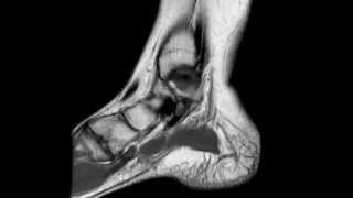 Ankle MRI anatomy [upl. by Aicilec912]