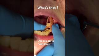 FLIPPER Partial Denture  tooth vlog [upl. by Martineau]