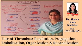 Fate of Thrombus Resolution Propagation Embolization Organization amp Recanalization [upl. by Jillene517]