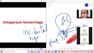 د السكري antepartum hemorrhage APH [upl. by Analihp]