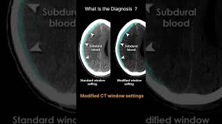 Modified CT window settings Acute CT Brain Patient and image information 41 radiologychannel007 [upl. by Annayi]