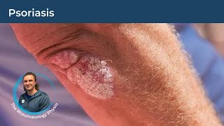 An Introduction To Psoriasis  INFLAMED SKIN  20 Minute Webinar [upl. by Yecrad]