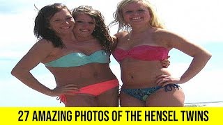 27 Photos of the Amazing Hensel Twins  LIST KING [upl. by Starr]