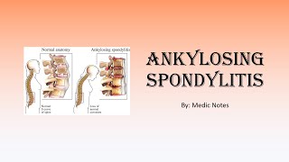 Ankylosing spondylitis  signs and symptoms Schober test Faber test imaging treatment [upl. by Adnorrahs950]