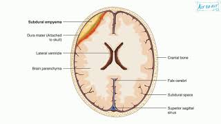 subdural empyema [upl. by Obe164]