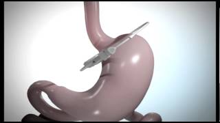 Bariatric Weight Loss  Laparoscopic Adjustable Gastric Band [upl. by Haididej]