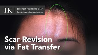 Treatment of Morphea en coup de sabre using Fat Transfer for forehead scar  Dr Hooman Khorasani [upl. by Bergman409]