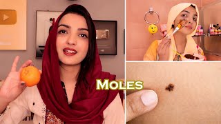 Remove BrownBlack Moles amp Get Freckles Free Face Simple Home Remedy [upl. by Olnek81]