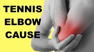 Tennis Elbow Causes amp Test Lateral Epicondylitis [upl. by Damas]