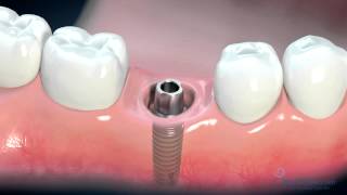 Dental Implant Consent Video [upl. by Dulci]