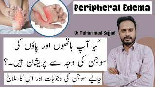 Peripheral Edema Symptoms Causes and Treatment  Comprehensive Guide [upl. by Eunice]